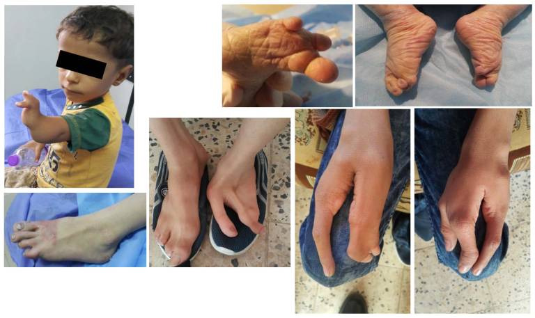Here’s another illustration, of hand and foot abnormalities in children in Nasiriyah, and in the ancient city of Ur, near the U.S. base: